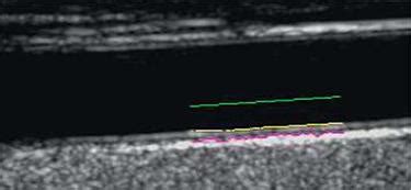 mobile intimal media thickness testing|intima media thickness test results.